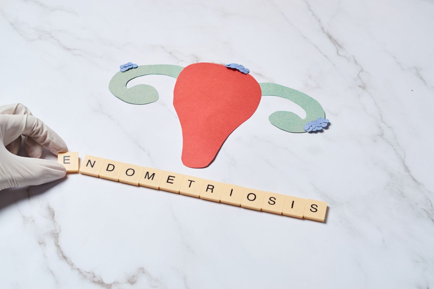Endometriosis & Fertility